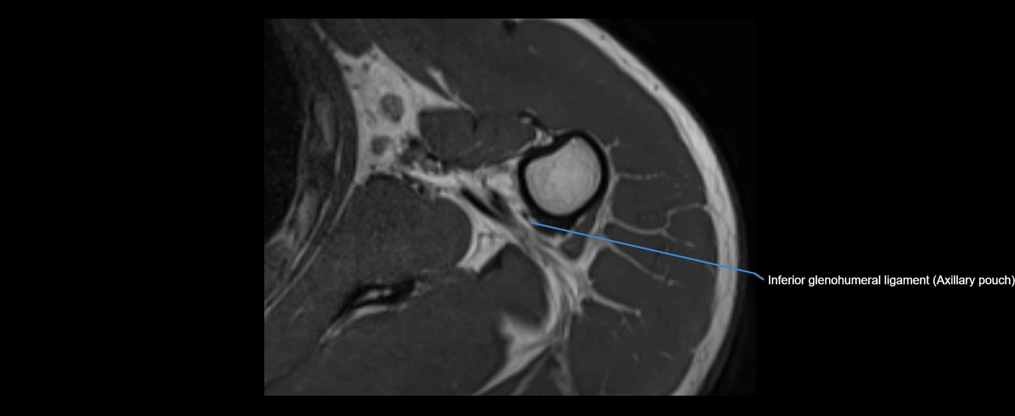 shoulder ligaments axial 3d 3t mri image-img-00005-00099.webp